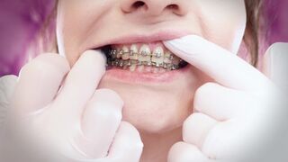 ASMR: upgraded braces with chain-link rubber bands and nitrile gloves (Arya Grander)